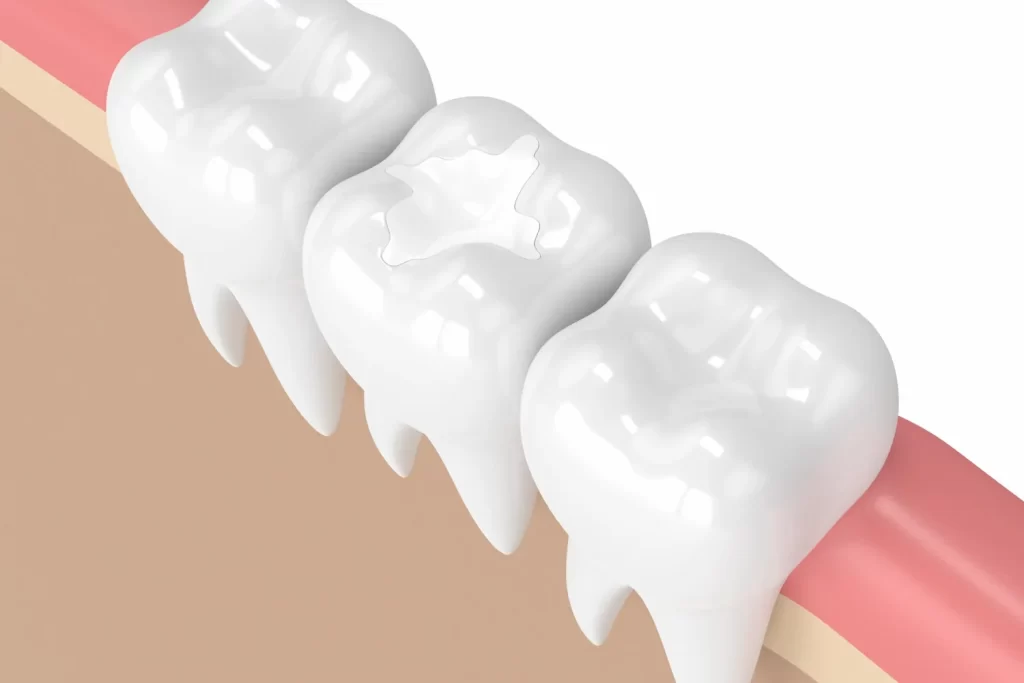 Composite Fillings Img 1