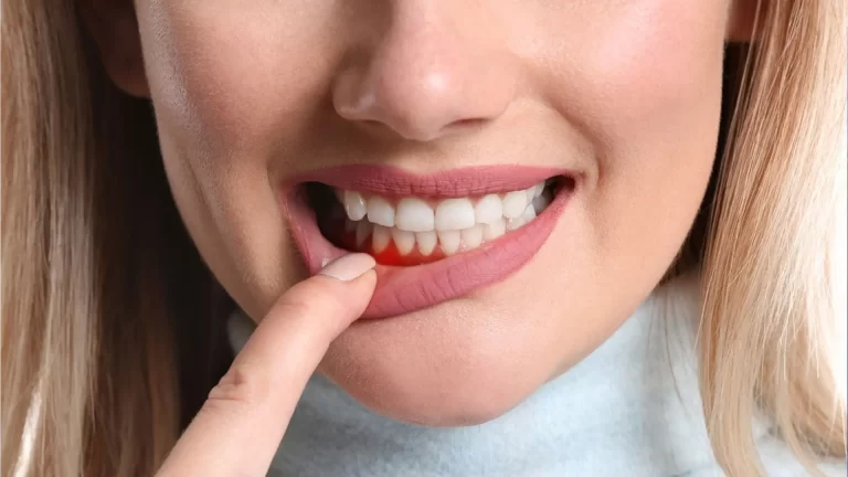 Periodontal Disease