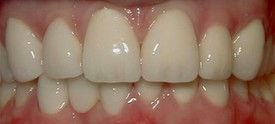 Porcelain Crowns (Caps) After 1