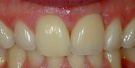 Porcelain Crowns (Caps) After 2