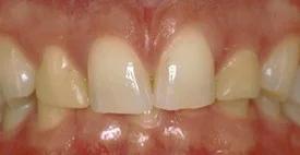 Porcelain Crowns (Caps) Before 1