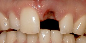 Porcelain Crowns (Caps) Before 2