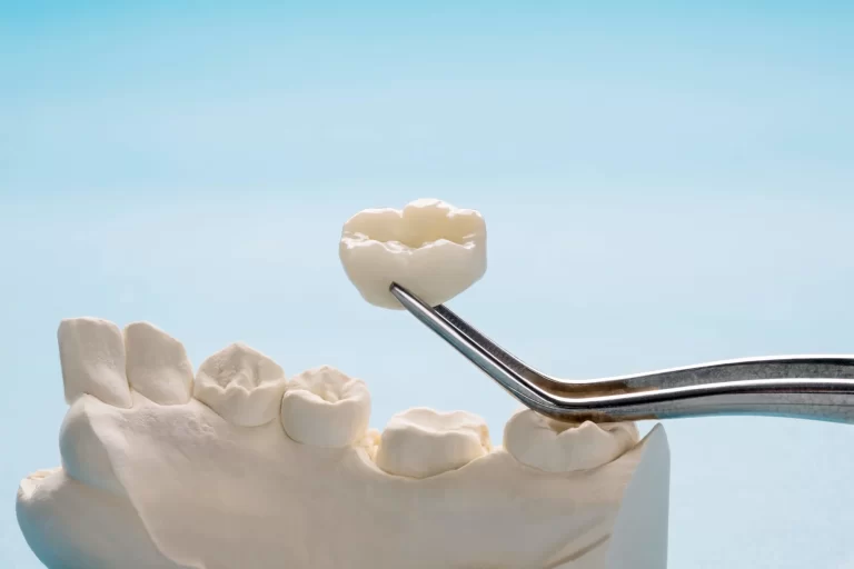 Porcelain Crowns (Caps)