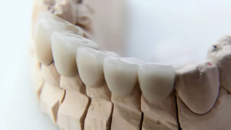Porcelain Fixed Bridges